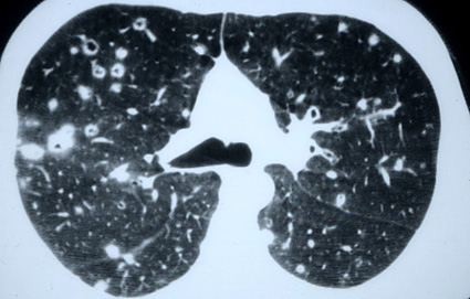 l atteinte pulmonaire de l adulte histiocytose org