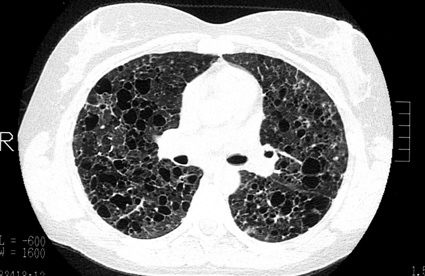 l atteinte pulmonaire de l adulte histiocytose org